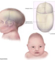 Hình ảnh minh họa một em bé bị hẹp khớp dọc (Sagittal Craniosynostosis) với đầu dài và hẹp.