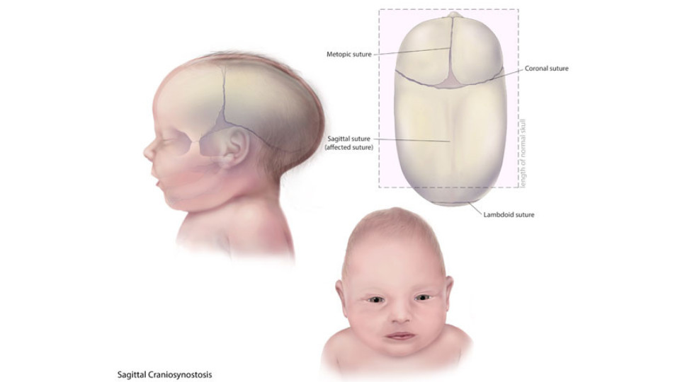 Hình ảnh minh họa một em bé bị hẹp khớp dọc (Sagittal Craniosynostosis) với đầu dài và hẹp.